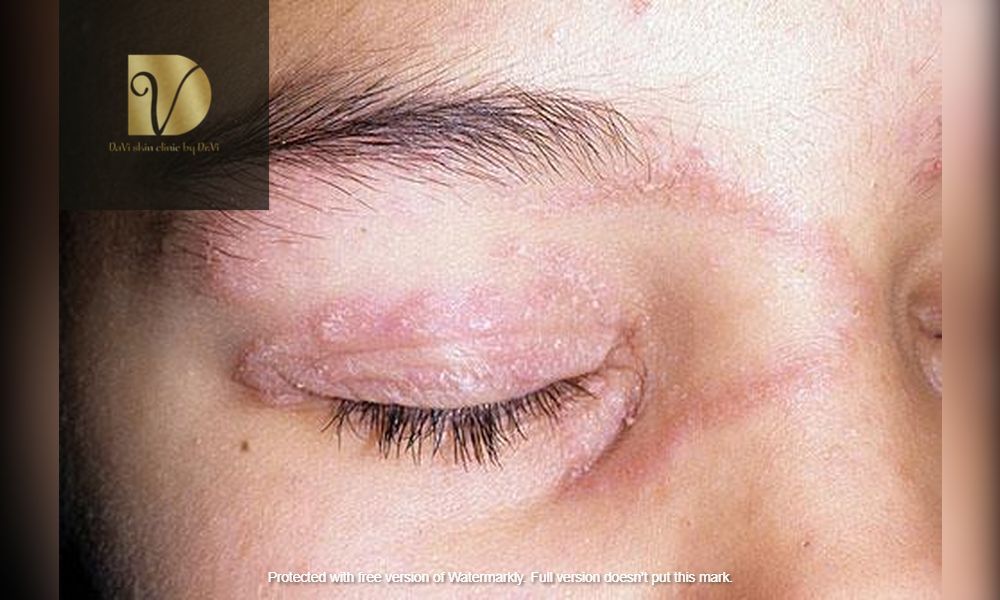 BANG-GIA-DIEU-TRI-BENH-LY-DA