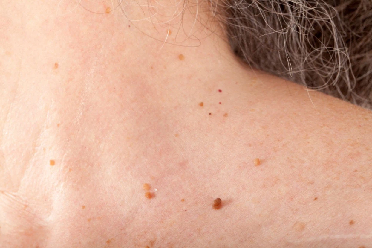 điều trị mụn thịt hiệu quả